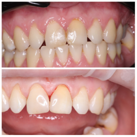 Прямая композитная реставрация 