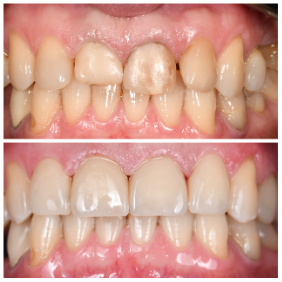 Непрямые методы реставрации