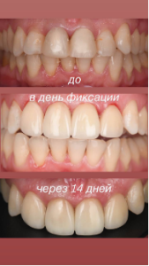 Реставрация до и после